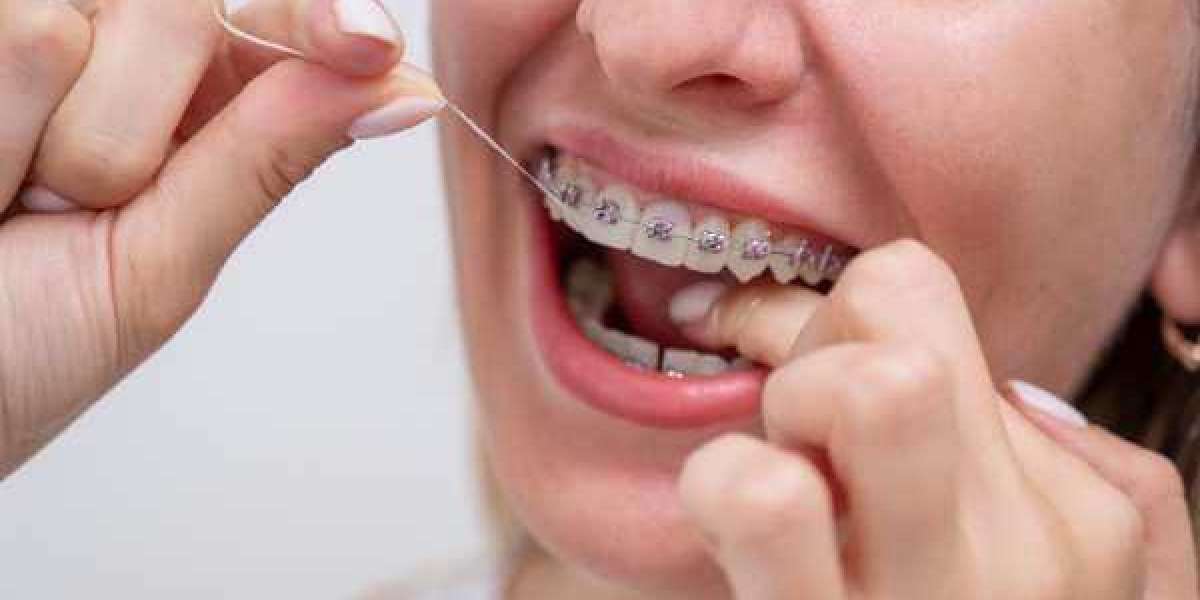 Discovering the Simplicity of Braces and Aligners in Barnstaple